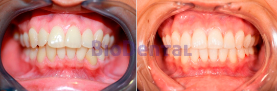 Ortodoncia convencional