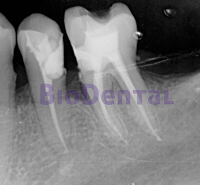 Endodoncias