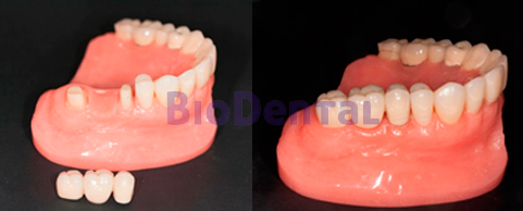 Tipo de prótesis dentales