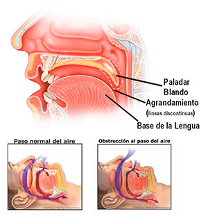 Roncadores