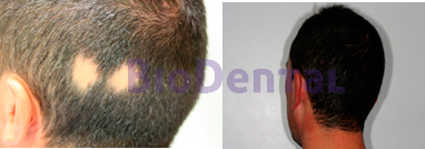 alopecia areata